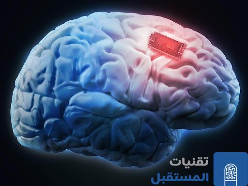 شريحة ذكية زرعت في دماغ رجل مشلول "ترجمت" أفكاره إلى نصوص بدقة 94%